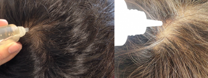 つむじハゲ対策室 頭頂部の薄毛の改善法とngな隠し方 髪型