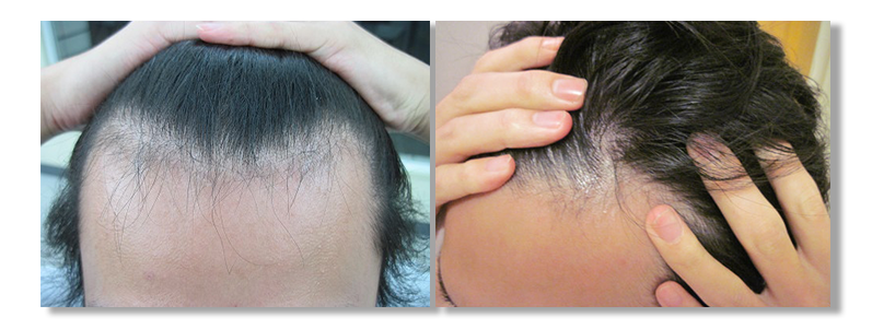 M字ハゲ復活 原因と対策まとめ 進行を予防そして発毛へ